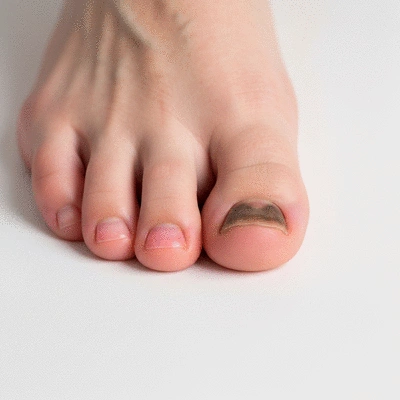 Close-up view of a person's foot with a healthy toenail and a toenail affected by onychomycosis, illustrating the difference before and after treatment, clean background, no text, no words, no typography, no labels, clean image
